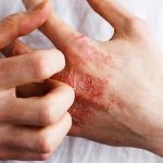 تأیید نخستین کرم برای درمان اگزمای مزمن دست از سوی سازمان غذا و داروی آمریکا