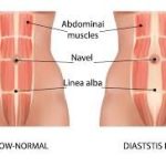 شکاف عضلات راست شکمی پس از زایمان: از تحقیقات پایه تا عمل بالینی + عکس